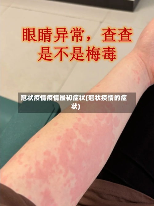 冠状疫情疫情最初症状(冠状疫情的症状)-第2张图片