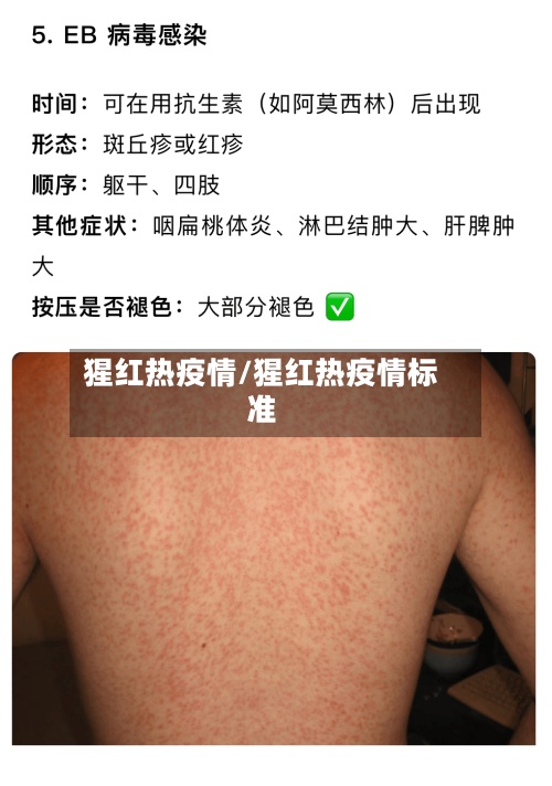 猩红热疫情/猩红热疫情标准