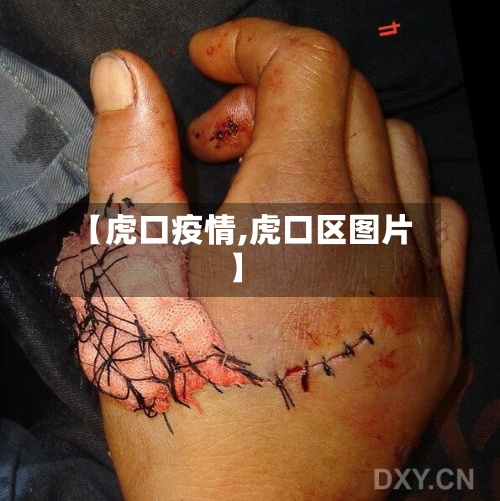 【虎口疫情,虎口区图片】