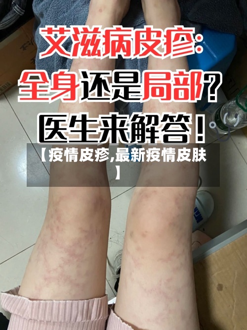【疫情皮疹,最新疫情皮肤】