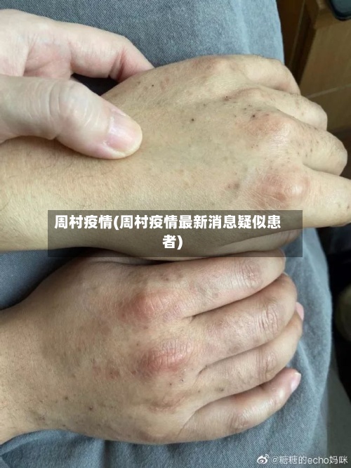 周村疫情(周村疫情最新消息疑似患者)-第2张图片