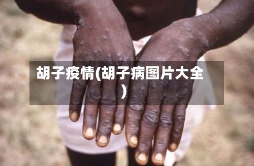 胡子疫情(胡子病图片大全)