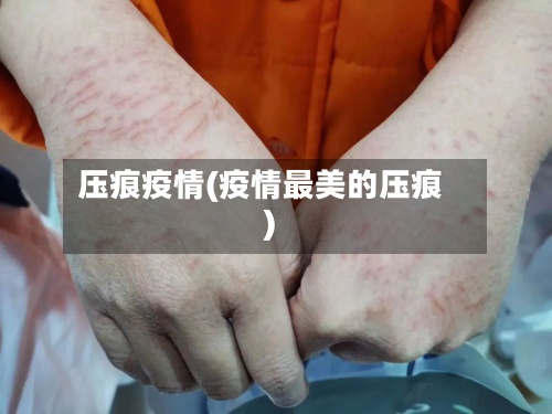 压痕疫情(疫情最美的压痕)-第3张图片