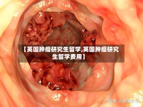 【英国肿瘤研究生留学,英国肿瘤研究生留学费用】-第3张图片